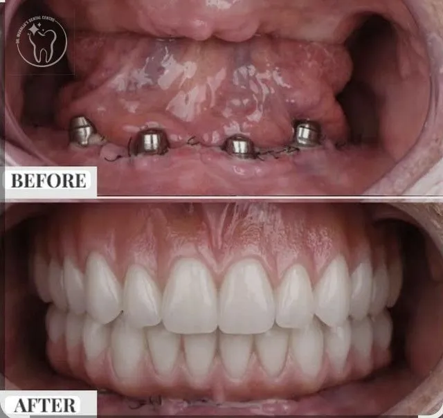 Dental implants — dentist placing a titanium implant in a modern operatory