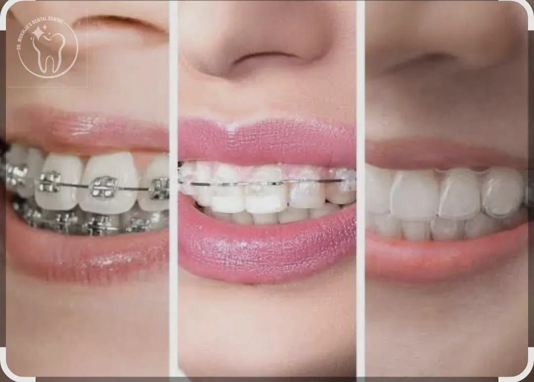 Braces, Invisalign, and Smile Makeovers in Sonipat: Picking What Actually Fits Your Life