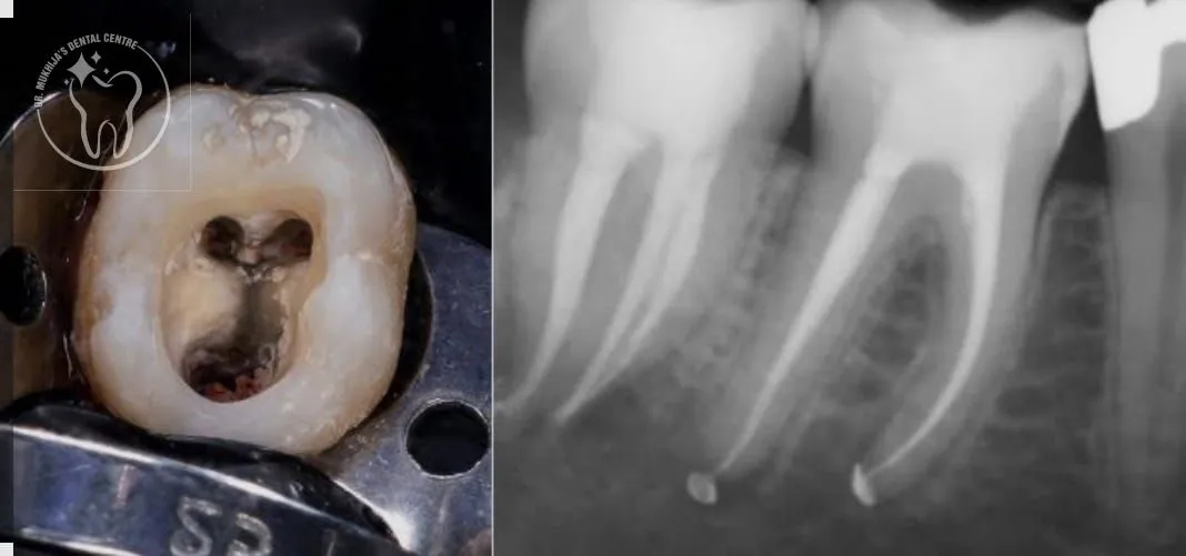 Root Canal Treatment in Sonipat: What Actually Happens (And Why the Fear Is Outdated)